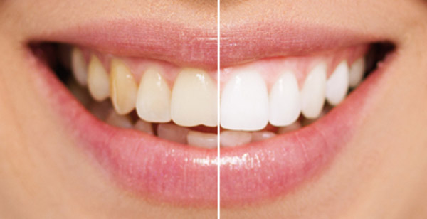 Ein Lächeln vor und nach dem Bleaching. 
							Auf der rechten Hälfte sind die Zähne deutlich heller.