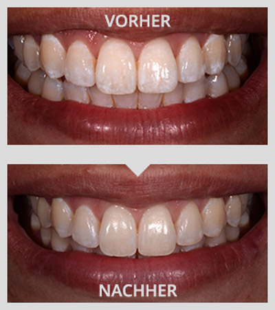 Ein Lächeln vor und nach der Behandlung mit Icon. 
							Auf der unteren Hälfte sind deutlich weniger Flecken im Zahnschmelz.