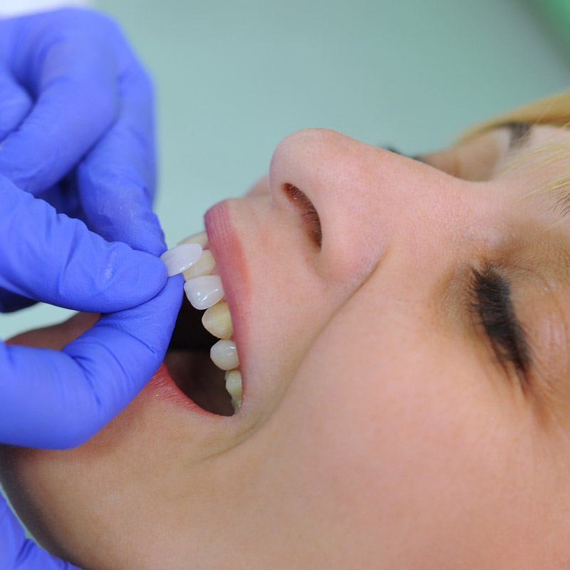 Die Veneers werden vor dem Kleben einprobiert.
