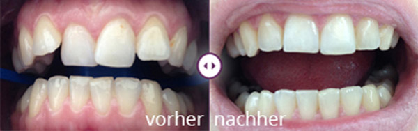 Ein Beispiel vorher und nachher. Anfangs 
							mit schiefen Zähnen, am Ende alles harmonisch in einer Reihe.